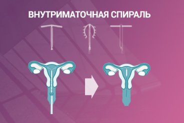 Как выбрать внутриматочную спираль