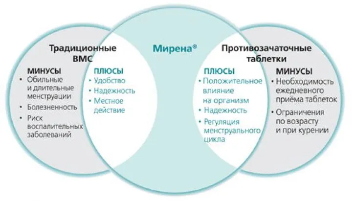Преимущества спирали Мирена