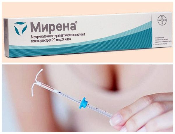 ВМС МИРЕНА при эндометриозе
